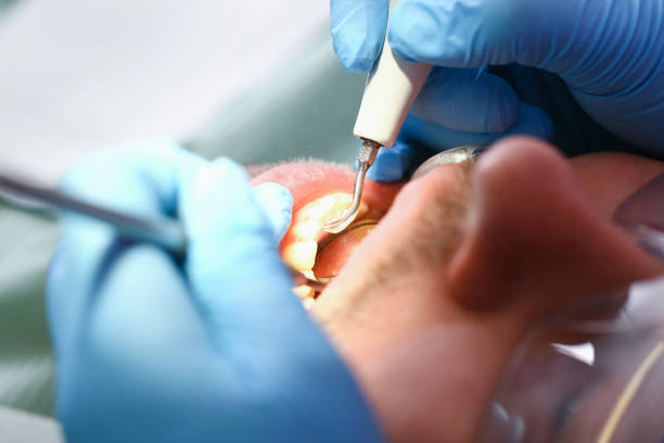Best Knocked-Out Tooth (Avulsed Tooth) Treatment in Wayland, MI